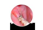 Professional Wisdom Tooth Extraction - Safe & Comfortable