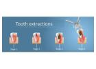 Enhance Your Smile with Cosmetic Tooth Extractions in Frisco