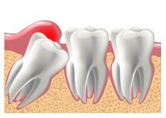 Professional Wisdom Tooth Extraction Safe, Quick, and Affordable Care