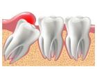 Gentle & Affordable Wisdom Tooth Extraction