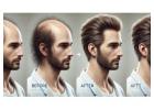 Hair Loss Treatment Ahmedabad