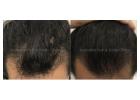 Effective Ways to Manage Hair Thinning and Restore Confidence